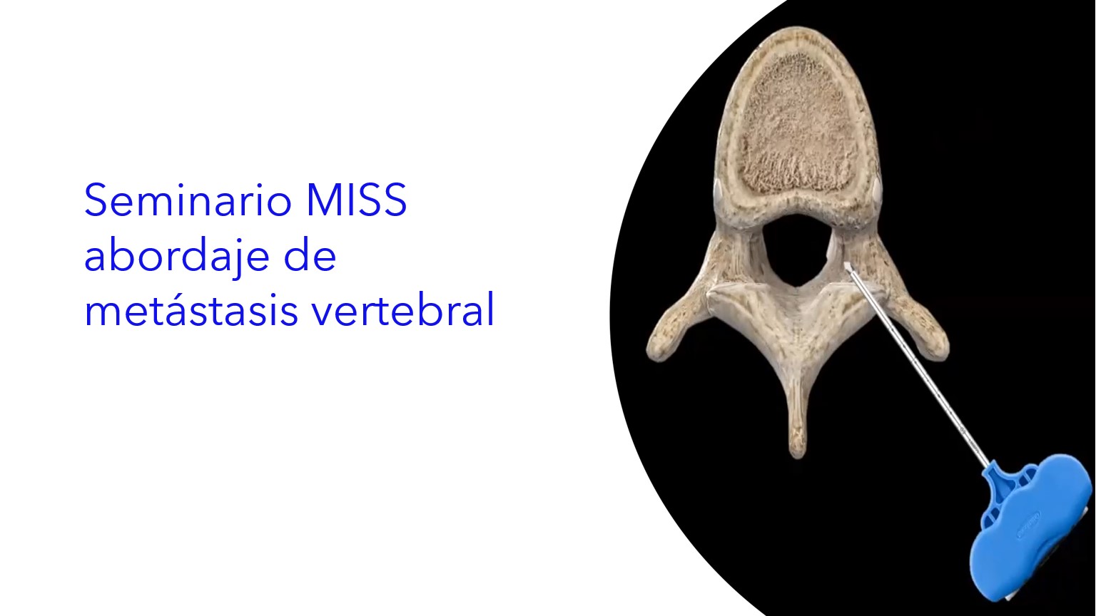 Seminario MISS Abordaje de Metástasis Vertebral. | Seminário Abordagem MISS de Metástase Vertebral .| MISS Approach to Vertebral Metastasis Seminar.  