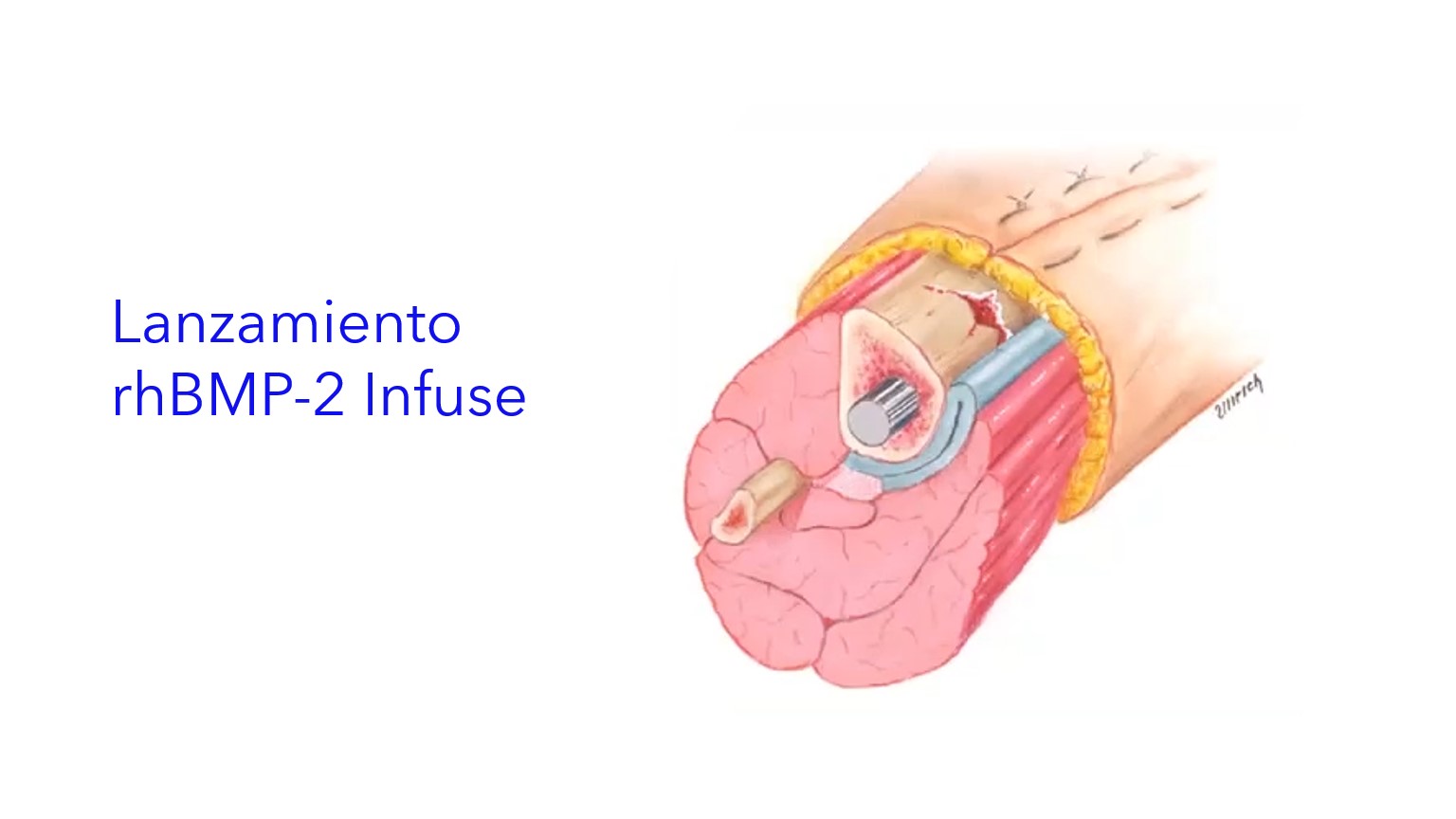 Lanzamiento rhBMP-2 Infuse