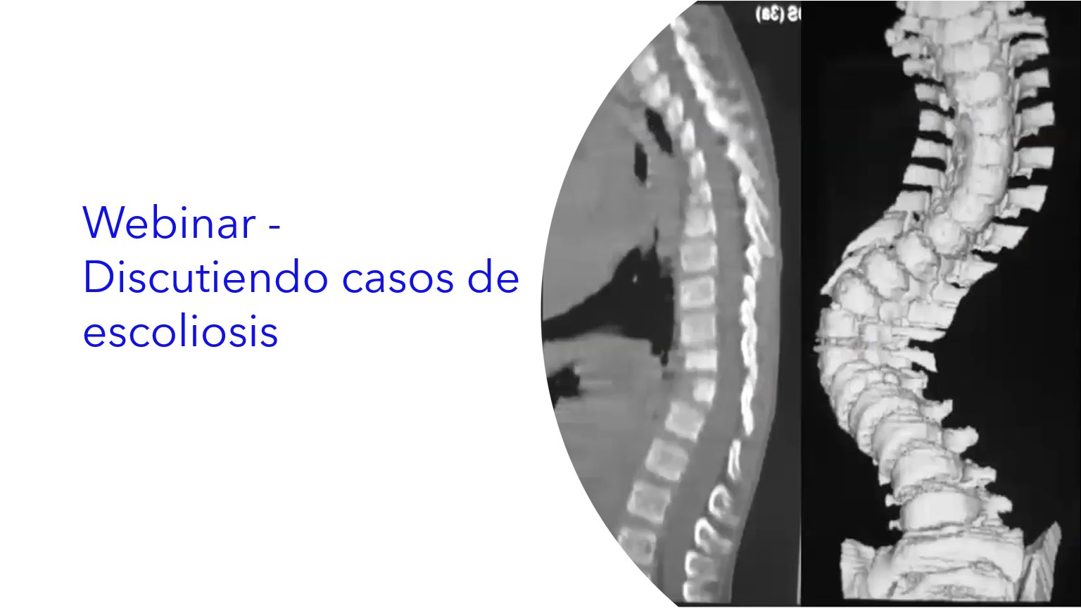 Webinar - Discutiendo Casos de Escoliosis.|Webinar - Discutindo Casos de Escoliose,|Webinar - Discussing Scoliosis Cases