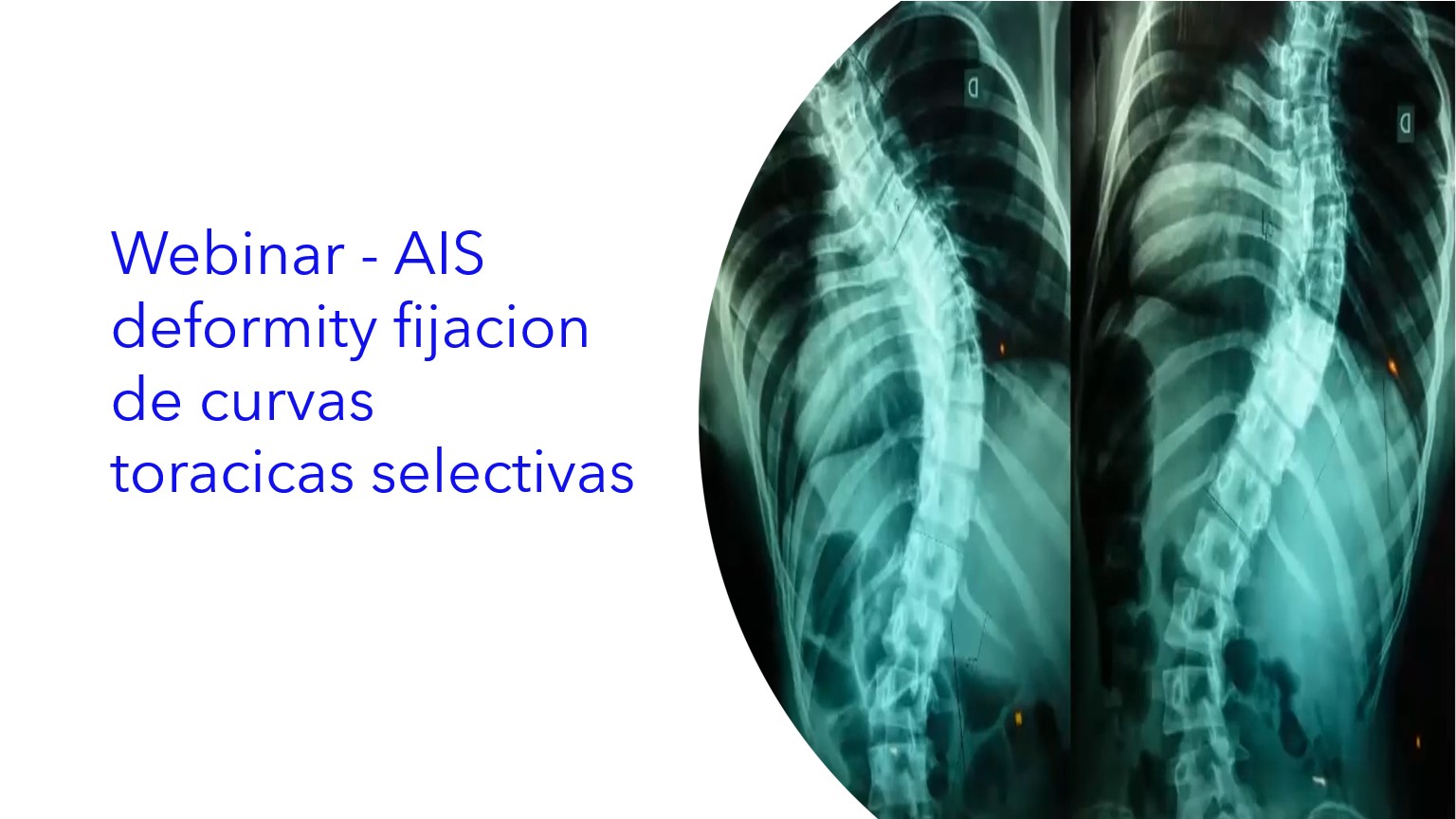 Webinar - AIS Deformity Fijacion de Curvas Toracicas Selectivas.|Webinar - Fixação de Deformidades AIS de Curvas Torácicas Seletivas.|Webinar - AIS Deformity Fixation of Selective Thoracic Curves.