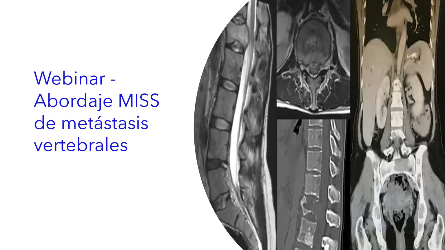 Webinar - Abordaje MISS de Metástasis Vertebrales.|Webinar - Abordagem MISS para Metástases Vertebrais.|Webinar - MISS Approach to Vertebral Metastases.