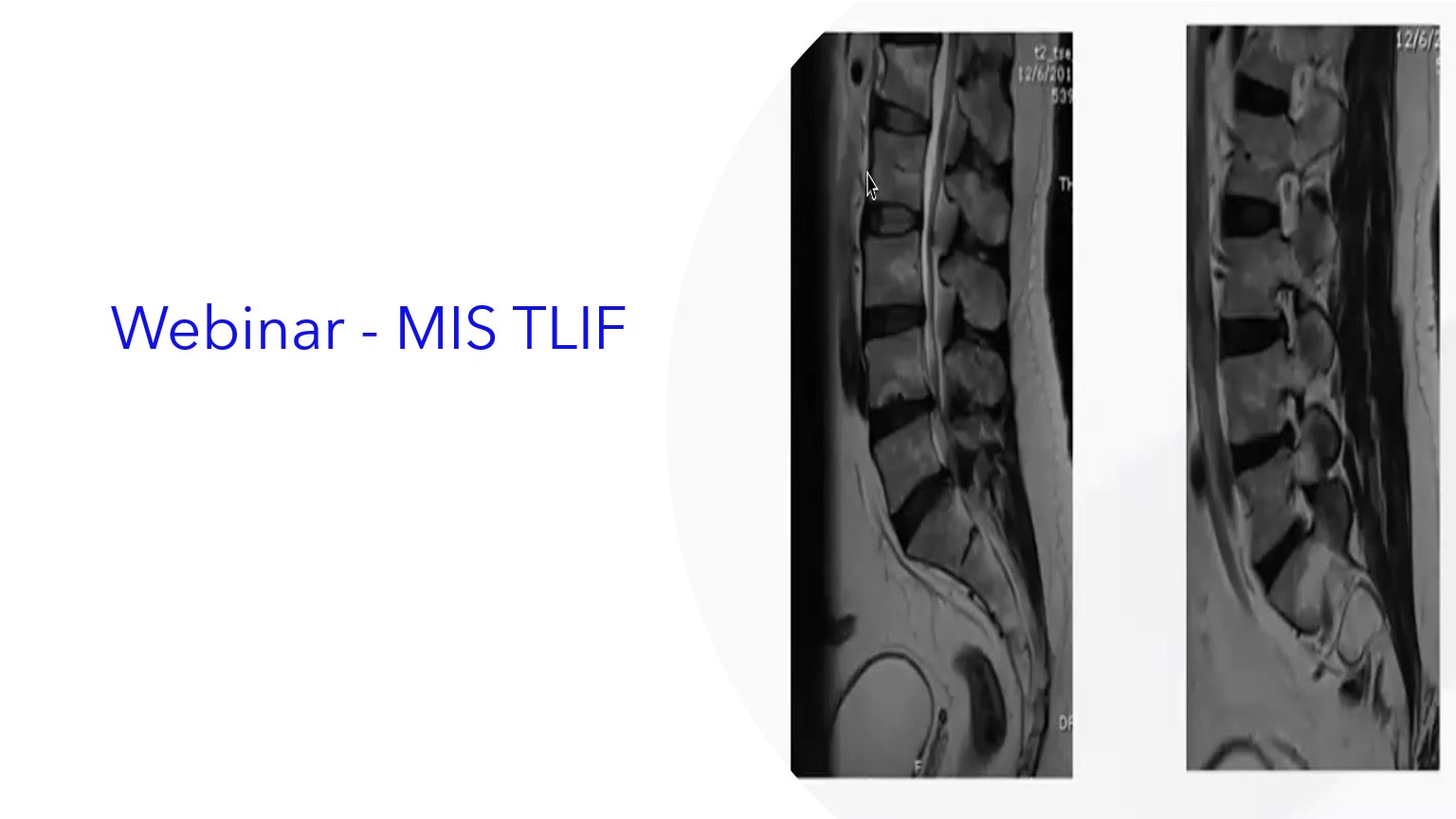 Webinar - MIS TLIF (ES).|Webinar - MIS TLIF (PT).|Webinar - MIS TLIF (EN).