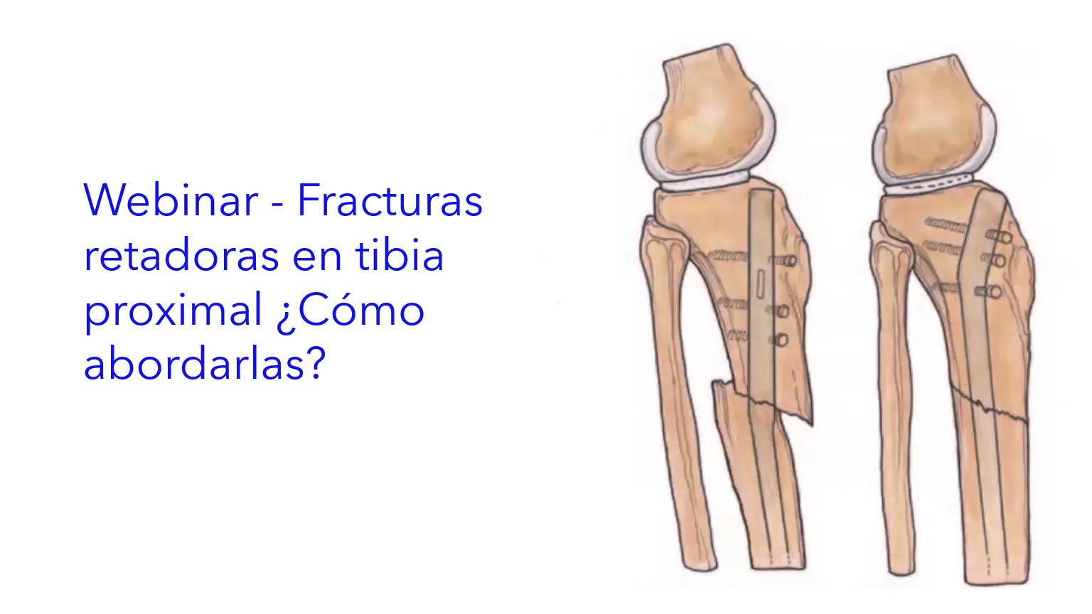 Webinar - Fracturas retadoras en Tibia Proximal ¿Cómo abordarlas?.|Webinar - Fraturas desafiadoras na tíbia proximal: como abordá-las?.|Webinar - Challenging fractures in the Proximal Tibia. How to address them?.