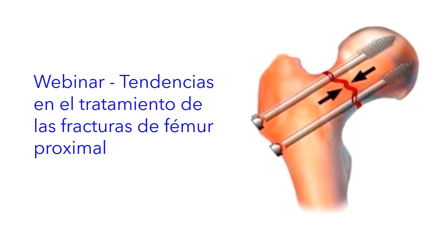 Webinar - Tendencias en el tratamiento de las fracturas de fémur proximal