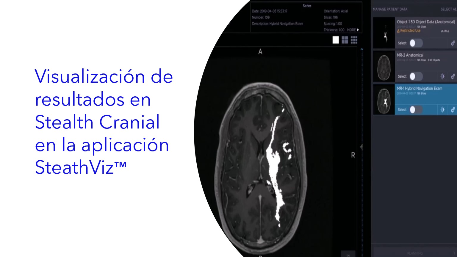 Visualización de resultados en Stealth Cranial en la aplicación SteathViz™.|Visualizando resultados Stealth Cranial no aplicativo SteathViz™.|Viewing Stealth Cranial Results in the SteathViz™ App.