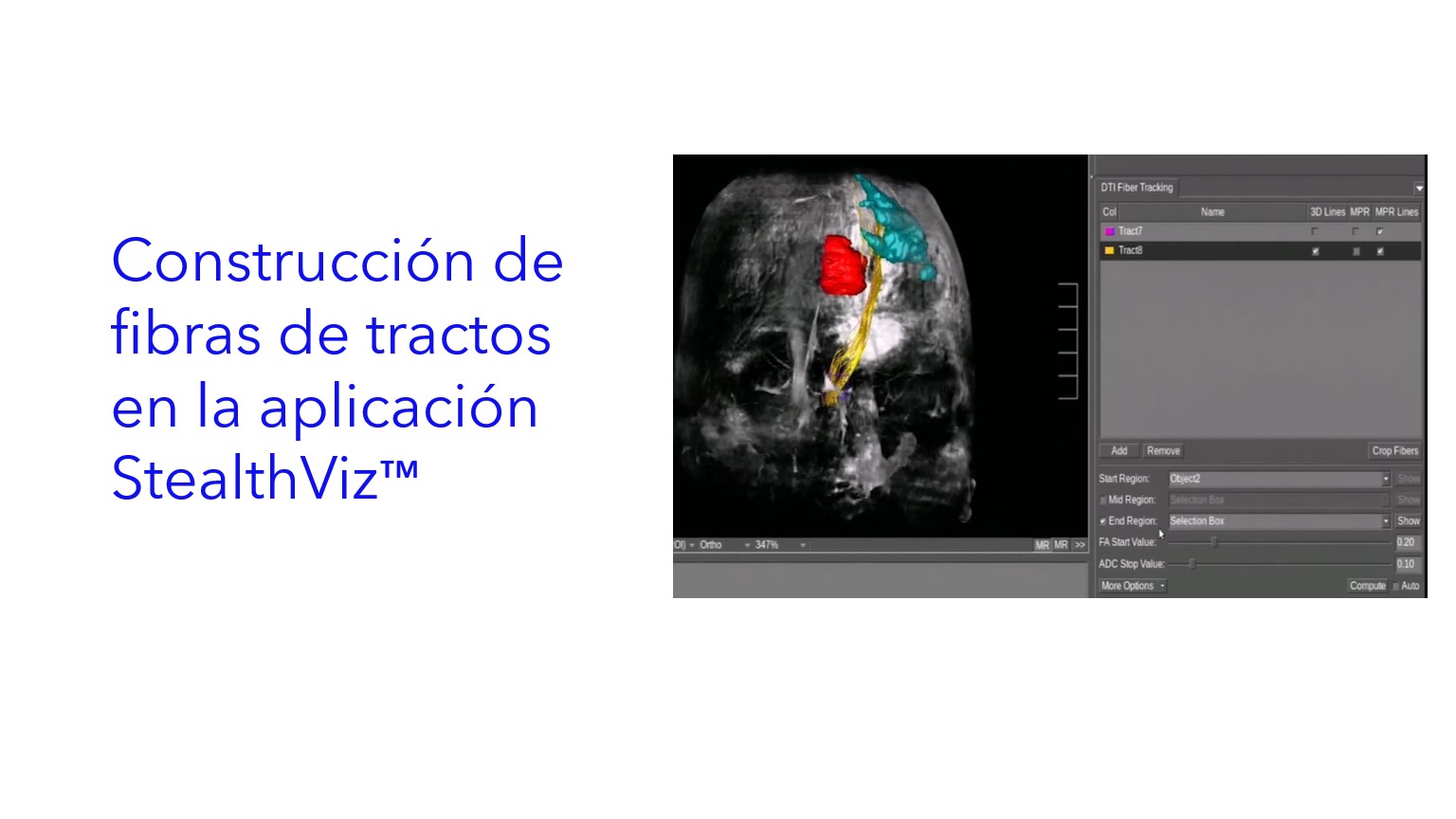 Construcción de fibras de tractos en la aplicación StealthViz™.|Construção de fibra de trato no aplicativo StealthViz™.|Tract fiber construction in the StealthViz™ application.