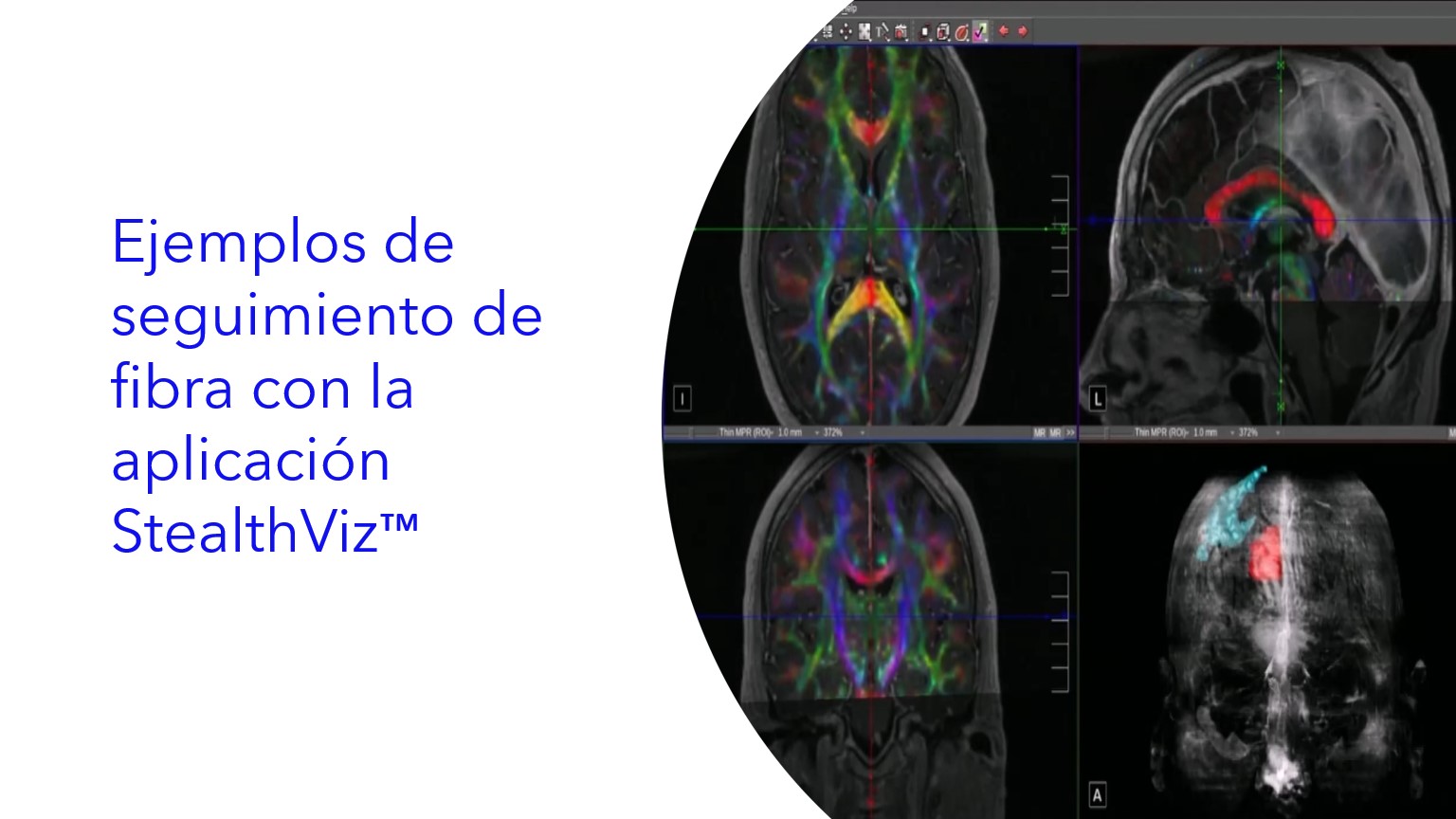 Ejemplos de seguimiento de fibra con la aplicación StealthViz™