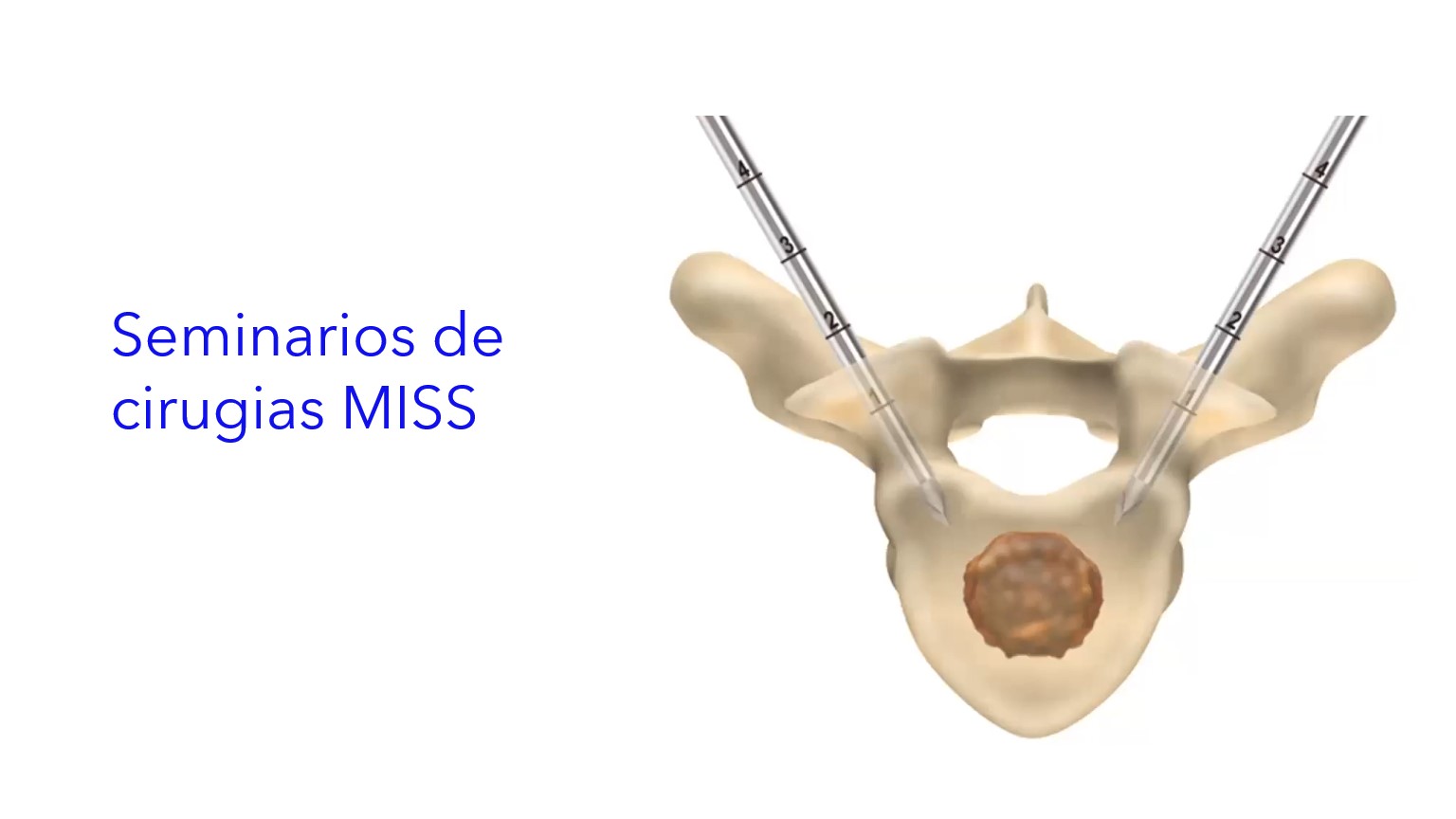 Seminarios de Cirugias MISS .| Seminários de Cirurgia MISS .| MISS Surgery Seminars.