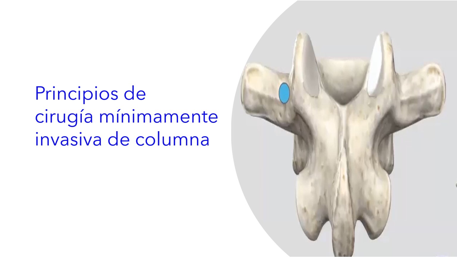 Principios de Cirugía Mínimamente Invasiva de Columna