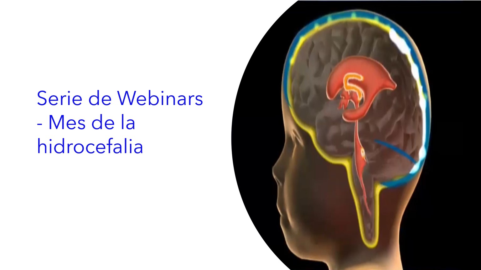 Serie de Webinars - Mes de la hidrocefalia.|Série de webinars - Mês da Hidrocefalia.|Webinar Series - Hydrocephalus Month.