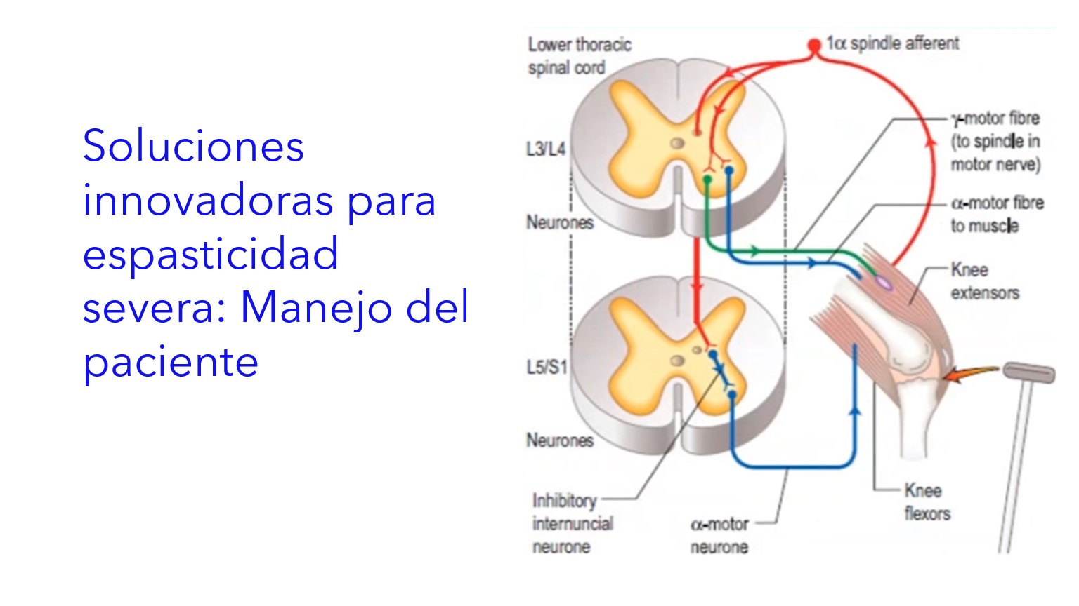 Soluciones Innovadoras para Espasticidad Severa: Manejo del Paciente