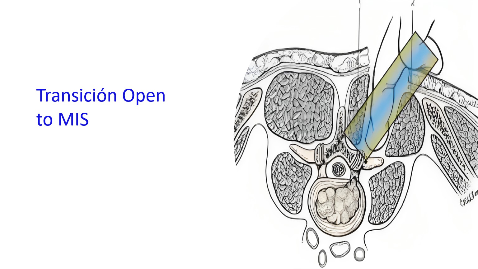 Transición Open to MIS