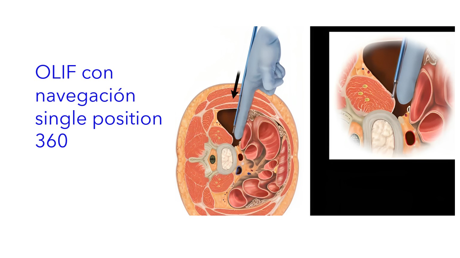 OLIF con Navegación Single Position 360