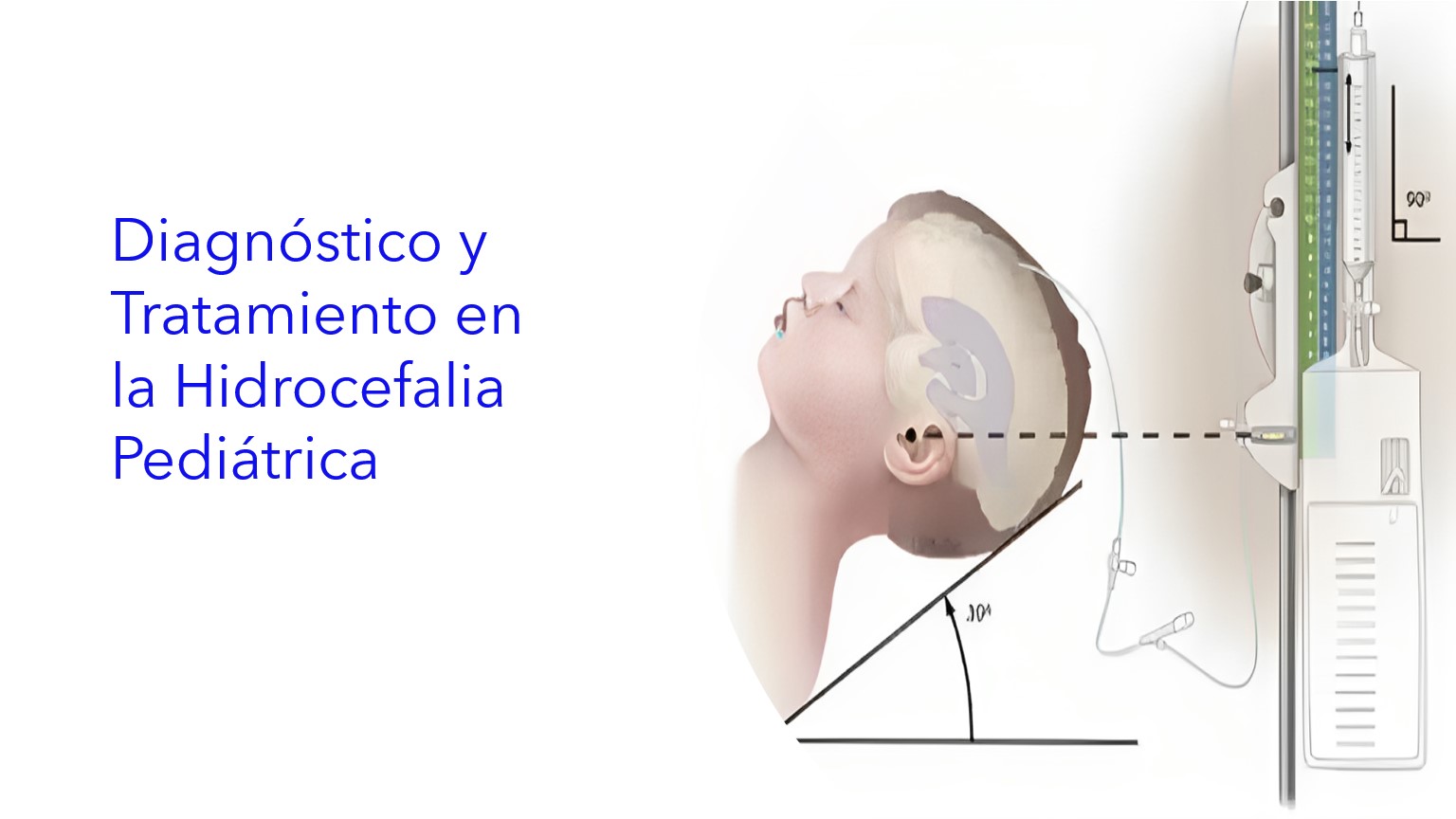 Diagnóstico y Tratamiento en la Hidrocefalia Pediátrica