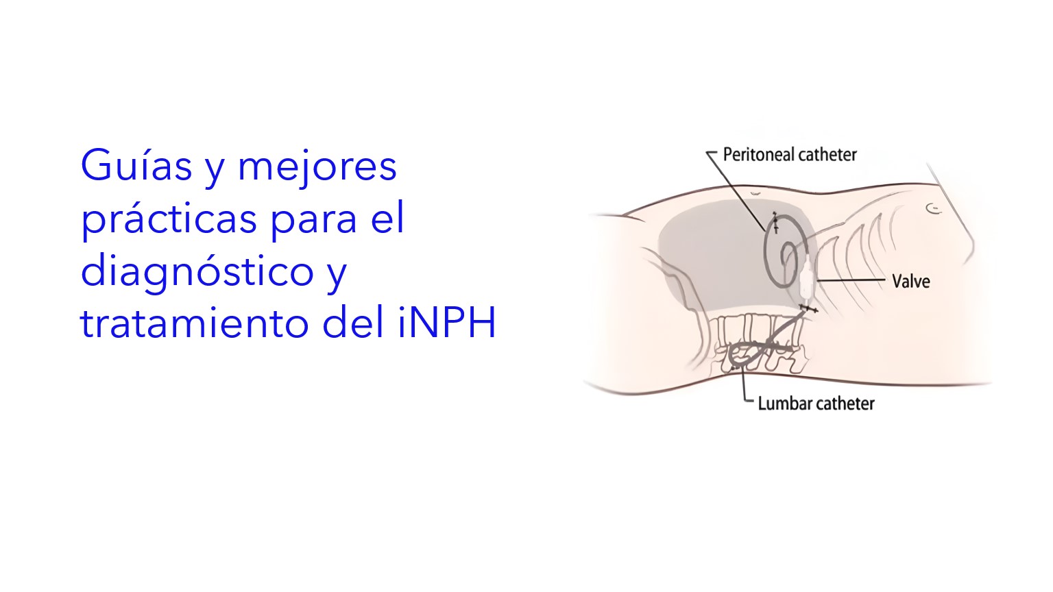 Guías y mejores prácticas para el diagnóstico y tratamiento del iNPH