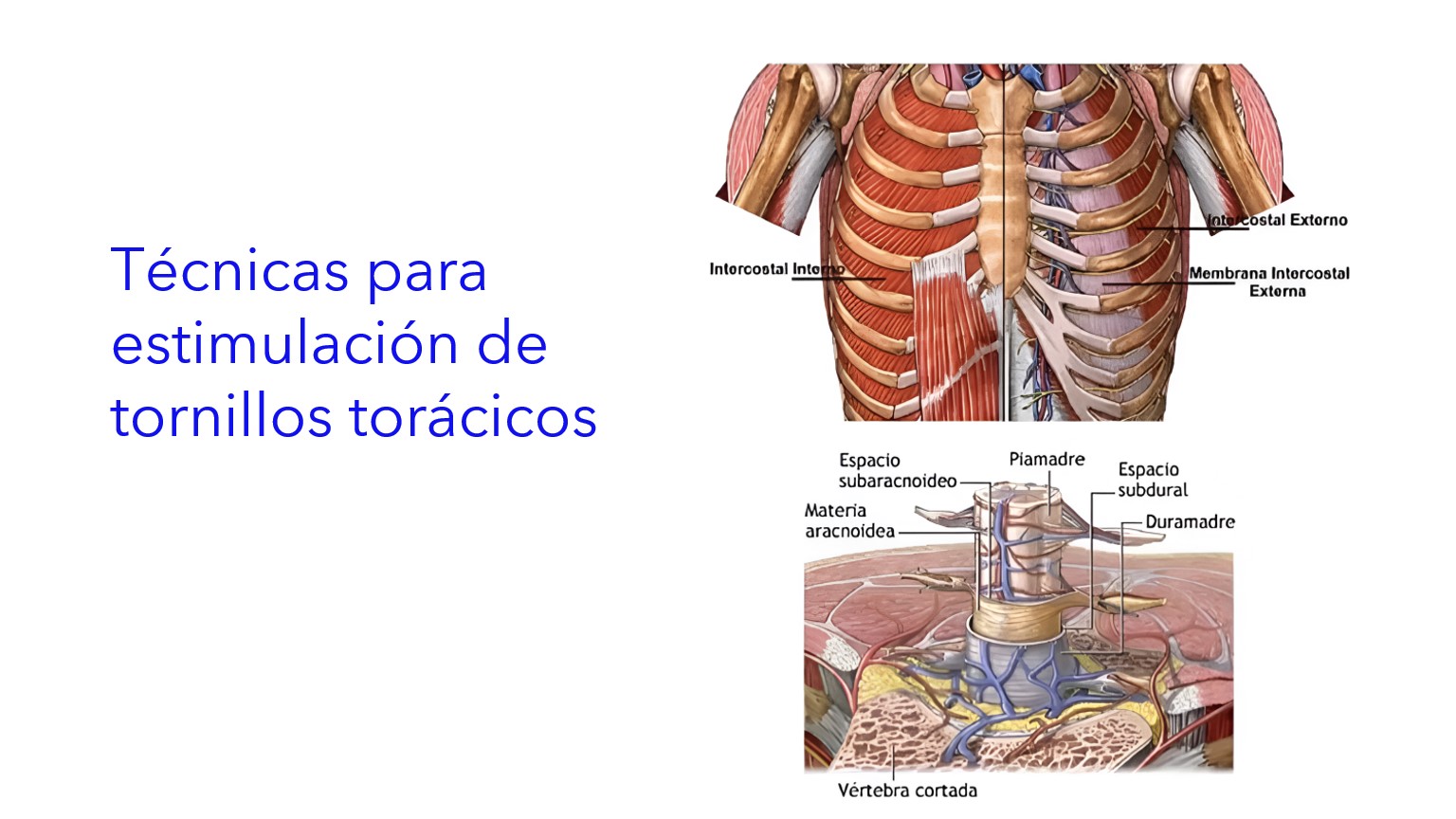 Técnicas para Estimulación de Tornillos Torácicos . | Técnicas para Estimulação de Parafusos Torácicos . | Techniques for Stimulation of Thoracic Screws .