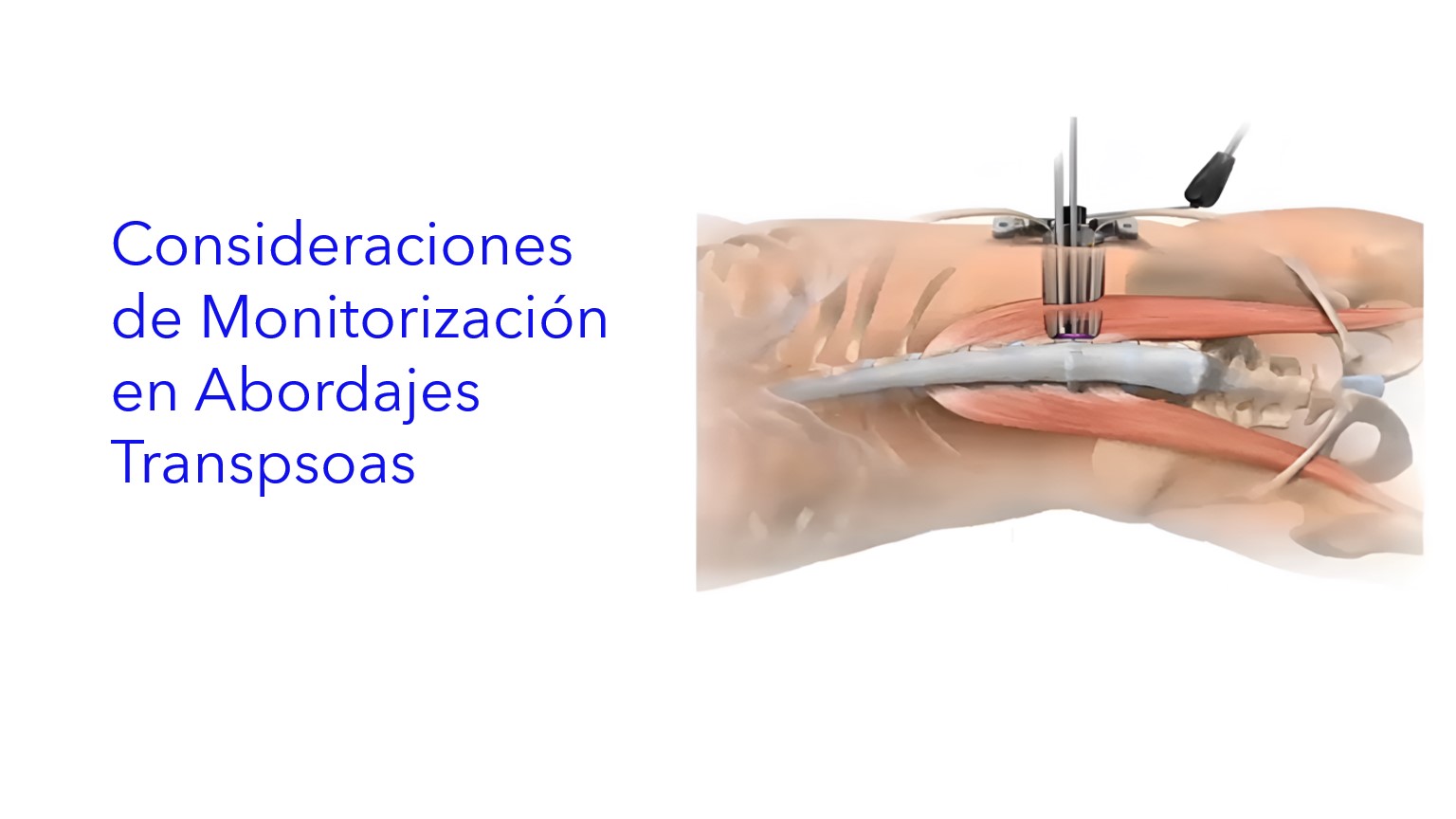 Consideraciones de Monitorización en Abordajes Transpsoas