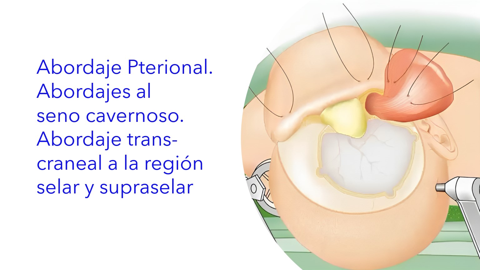 Abordaje Pterional. Abordajes al Seno Cavernoso. Abordaje trans-craneal a la región selar y supraselar 