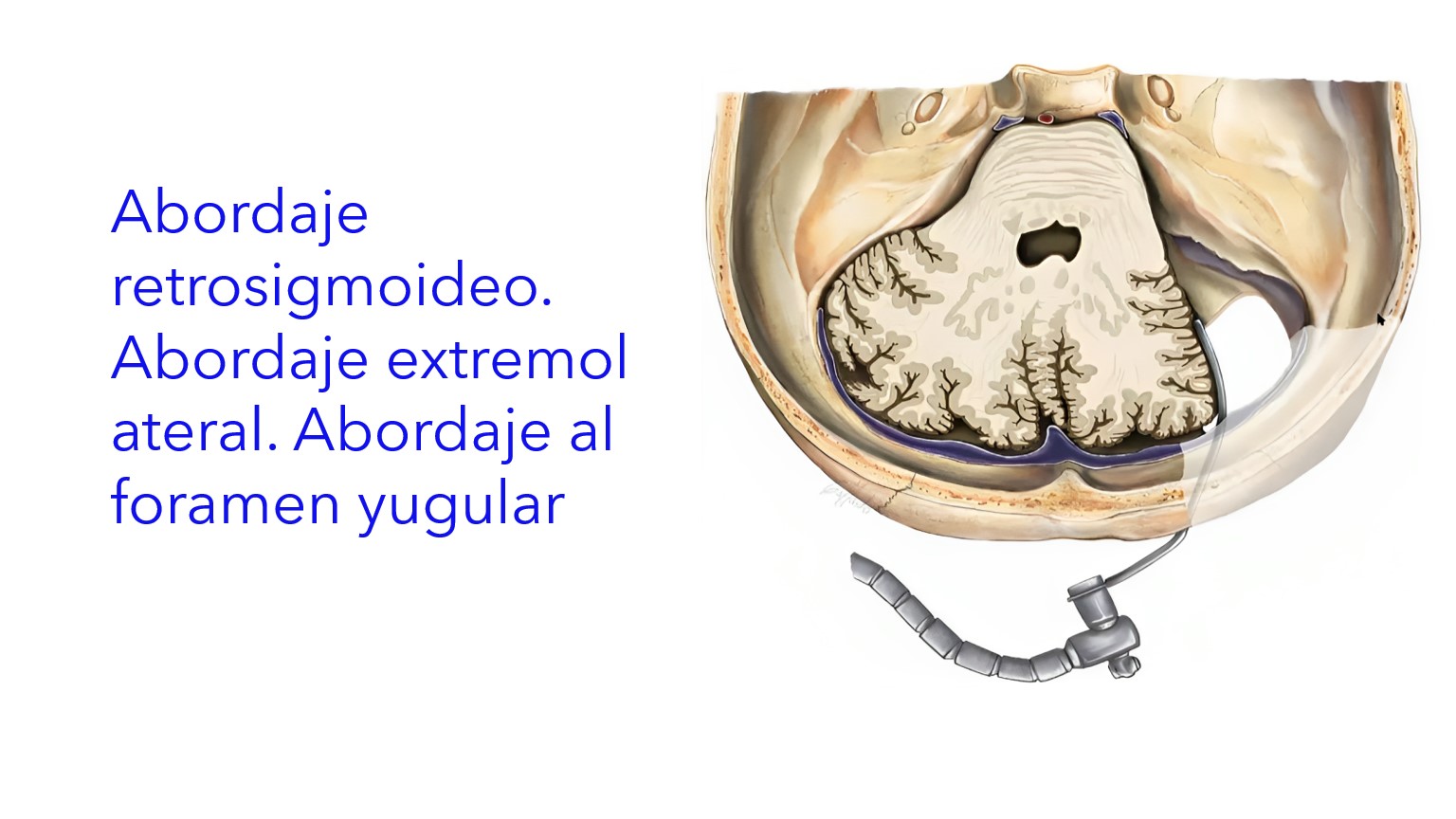 Abordaje Retrosigmoideo. Abordaje Extremolateral. Abordaje al Foramen Yugular